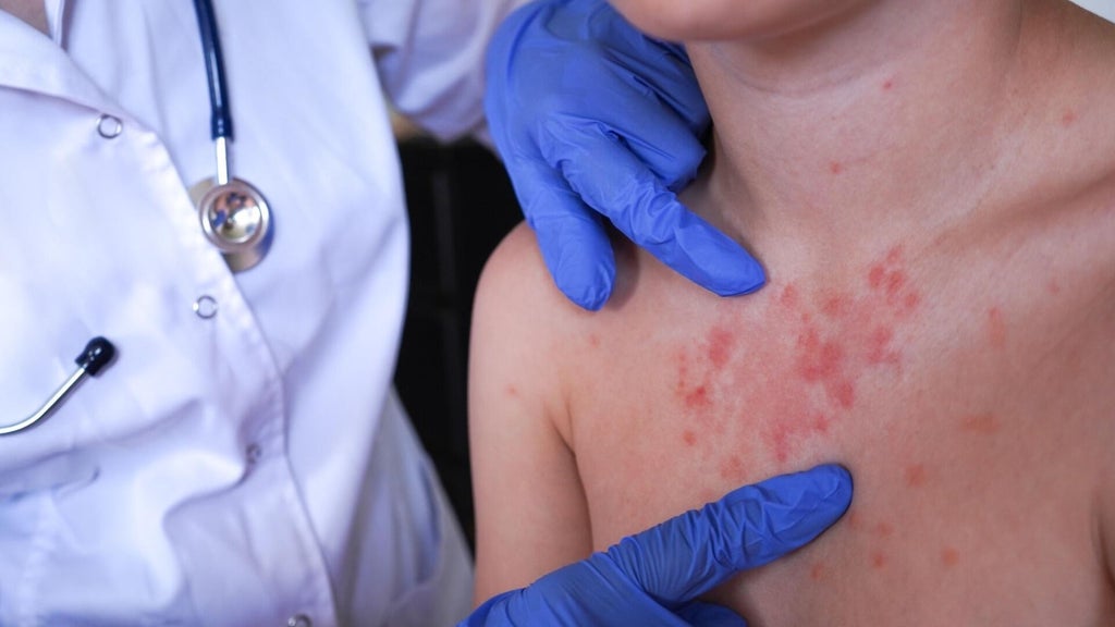 Minnesota's 80 measles cases this year are the most since 1990, health officials say — Waconia Health news